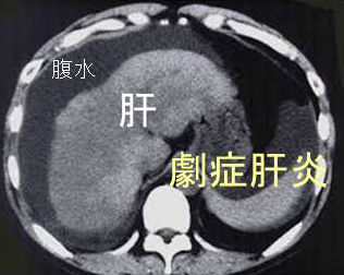 劇症肝炎　CT画像