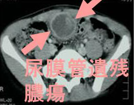 尿膜管遺残/尿膜管膿瘍