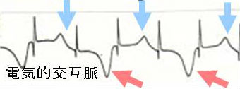たこつぼ型心筋症の心電図所見
