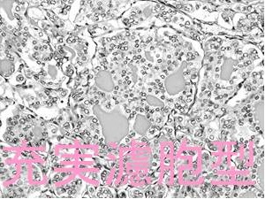 小児甲状腺乳頭癌充実濾胞型 組織像