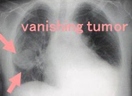 vanishing tumor