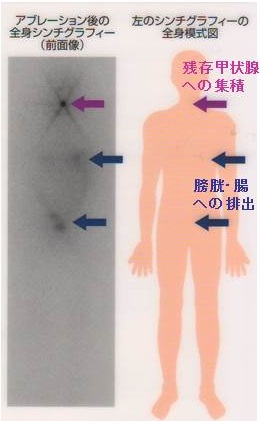 甲状腺癌全摘出した後の予測寿命
