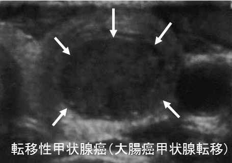 転移性甲状腺癌（大腸癌甲状腺転移）超音波(エコー)画像
