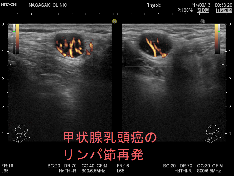 甲状腺乳頭癌のリンパ節再発 超音波ドプラー画像