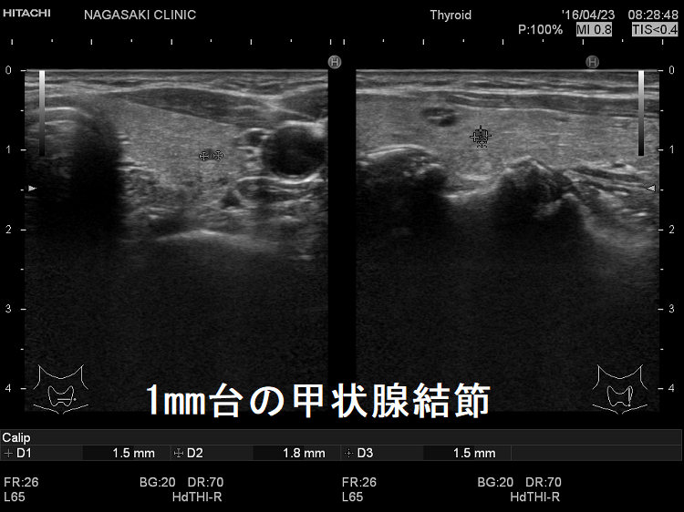 2mm未満の甲状腺腫瘍 超音波(エコー)画像