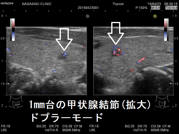 2mm未満の甲状腺腫瘍(拡大) 超音波(エコー)画像