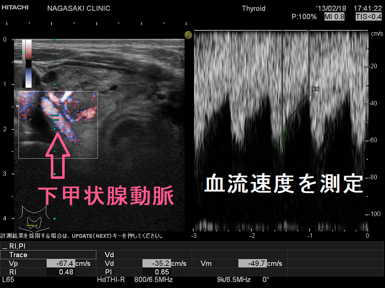 バセドウ病（甲状腺機能亢進症）再発・抗甲状腺薬の効き易さの予測