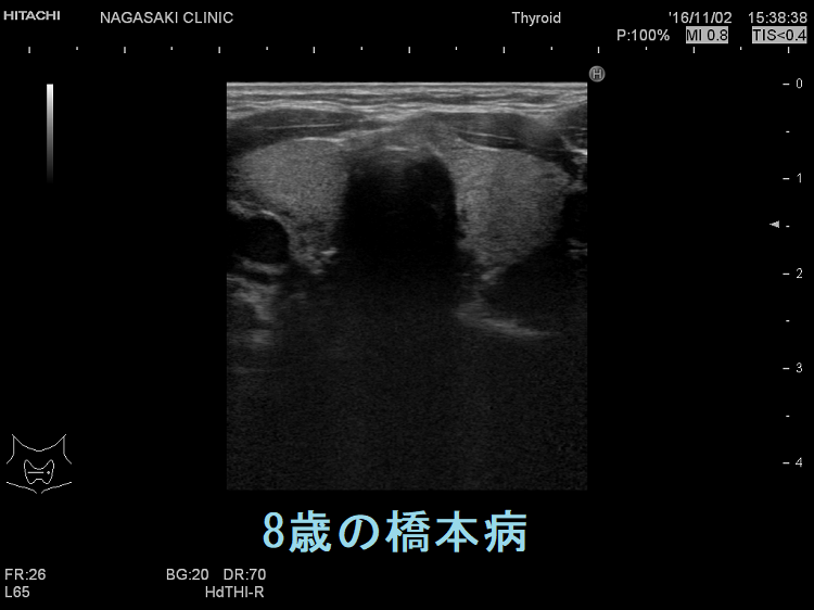 8歳の橋本病 超音波（エコー）画像