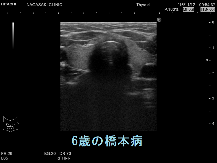 6歳女児の橋本病 超音波（エコー）画像（水平断）