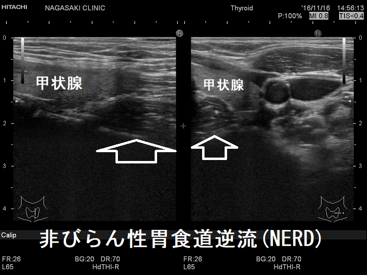 非びらん性胃食道逆流(NERD) 超音波(エコー)画像