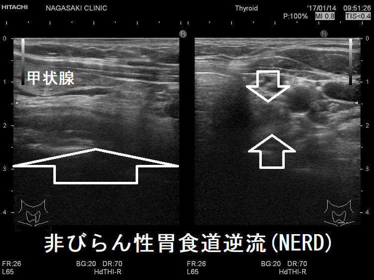 非びらん性胃食道逆流(NERD)　超音波(エコー)画像2