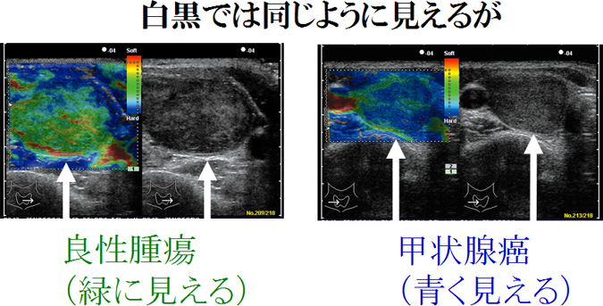 甲状腺腫瘍の良悪性（甲状腺癌・甲状腺腺腫）を見分けるエラストグラフィー