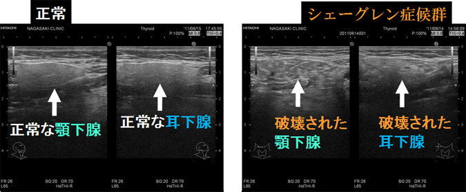 橋本病合併シェーグレン症候群 ドライアイ 口中乾燥 唾液腺 耳下腺 顎下腺 エコー 長崎甲状腺クリニ