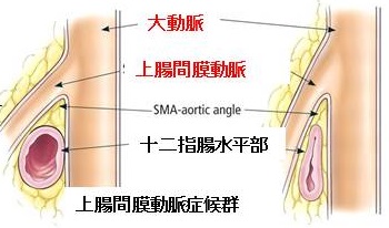 腸 間 と 動脈 症候群 は 膜 上 上腸間膜動脈症候群について