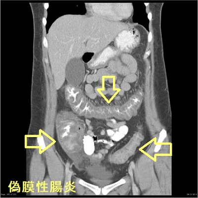 偽膜性大腸炎　CT画像