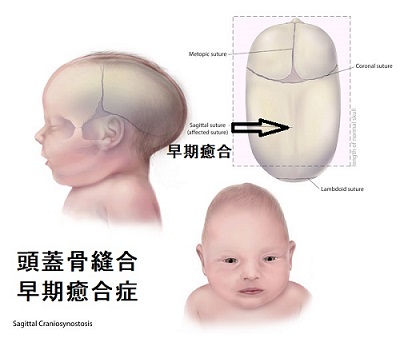 抗甲状腺薬メルカゾールによる胎児奇形 甲状腺 専門医 橋本病 バセドウ病 長崎甲状腺クリニック大阪