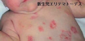 紅斑 環状 輪（環状）になる皮膚病