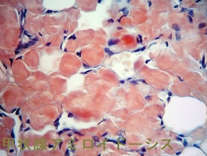 甲状腺アミロイドーシスの組織診 コンゴーレッド染色