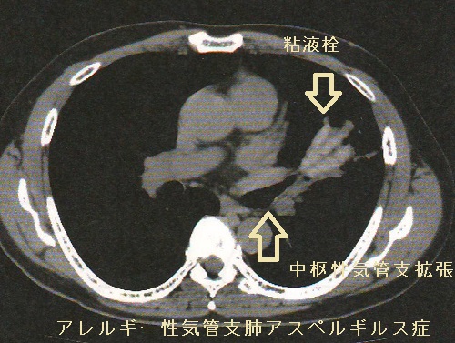 アレルギー性気管支肺アスペルギルス症 CT画像