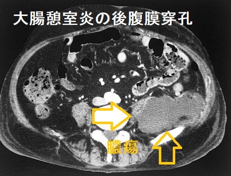 大腸憩室炎の後腹膜穿孔　造影CT