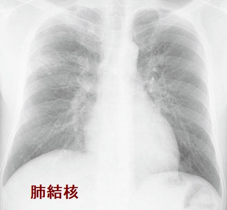 肺結核 単純X線