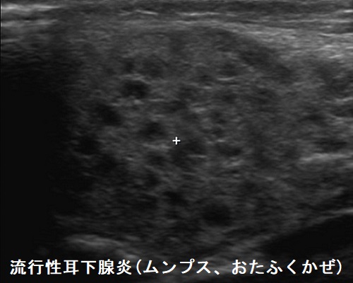 流行性耳下腺炎（ムンプス、おたふくかぜ）超音波(エコー)画像