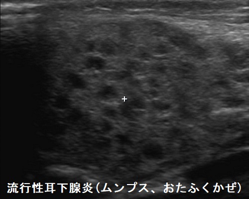 唾液腺(顎下腺,耳下腺)と甲状腺[日本甲状腺学会認定 甲状腺専門医 橋本病 バセドウ病 甲状腺超音波エコー 甲状腺機能低下症 長崎甲状腺クリニック大阪]