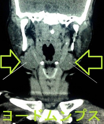 ヨードムンプス CT画像