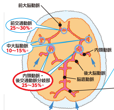 内頸動脈海綿静脈洞瘻