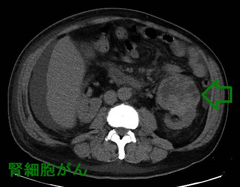 腎細胞がん　単純CT画像