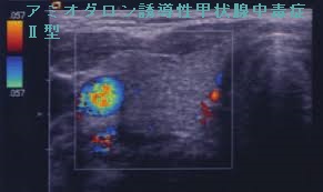 アミオダロン誘導性甲状腺中毒症Ⅱ型 超音波(エコー)画像