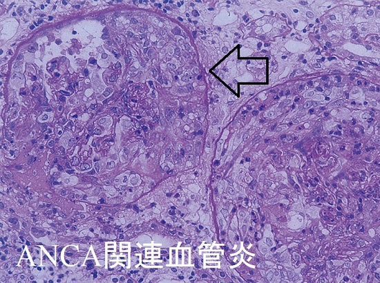ANCA関連腎炎