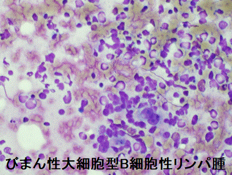 びまん性大細胞型B細胞性リンパ腫　細胞診
