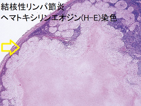 結核性リンパ節炎 リンパ節生検 ヘマトキシリンエオジン(H-E)染色