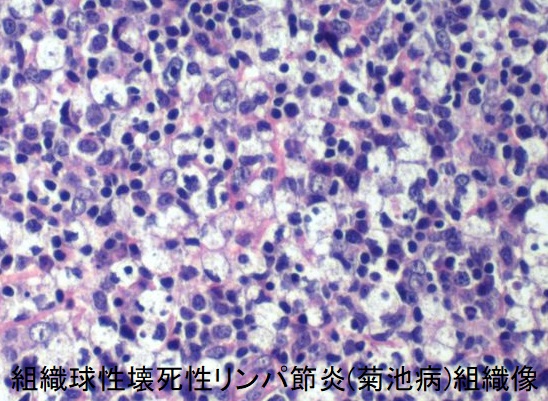 組織球性壊死性リンパ節炎(菊池病)組織像3
