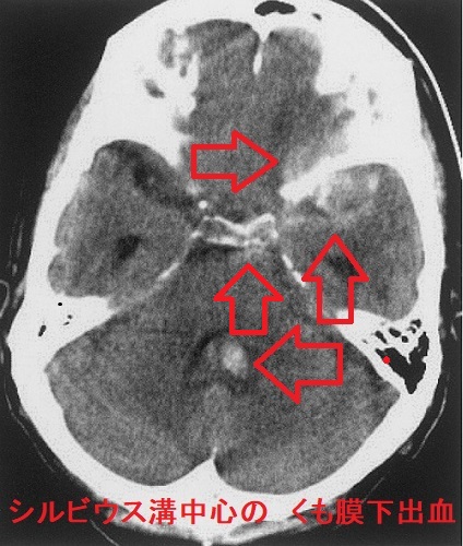 左Sylvius 裂を中心としたくも膜下出血と第4 脳室内への血液の逆流　単純CT画像