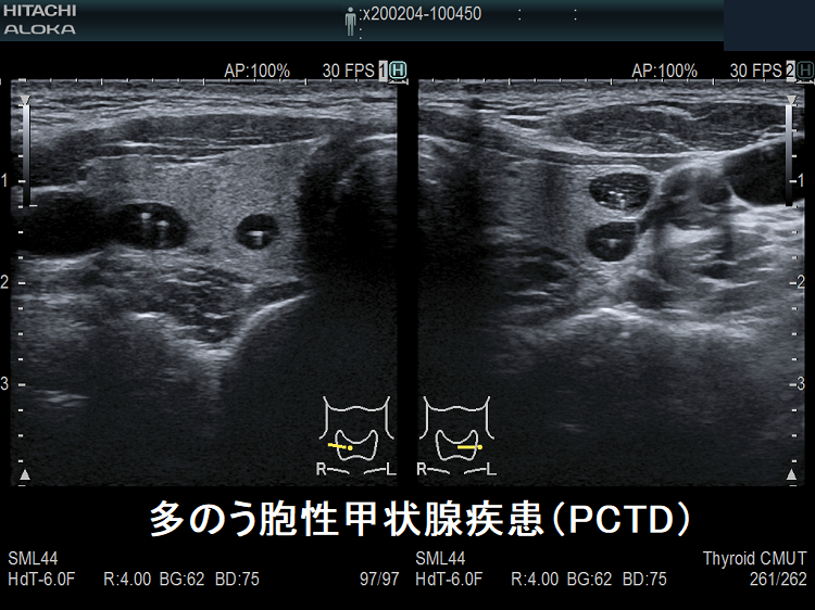 多のう胞性甲状腺疾患（PCTD） 超音波(エコー)画像