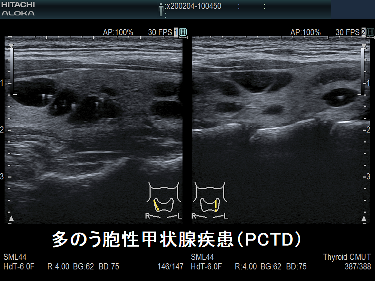多のう胞性甲状腺疾患（PCTD） 超音波(エコー)画像2