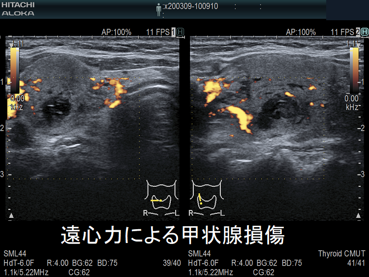遠心力による甲状腺損傷 超音波(エコー)画像 ドプラーモード