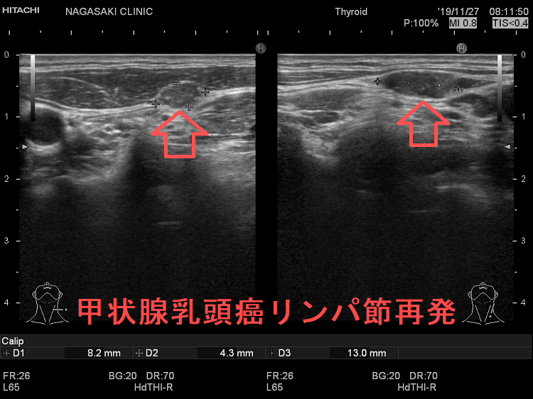 甲状腺乳頭癌リンパ節再発 超音波エコー画像