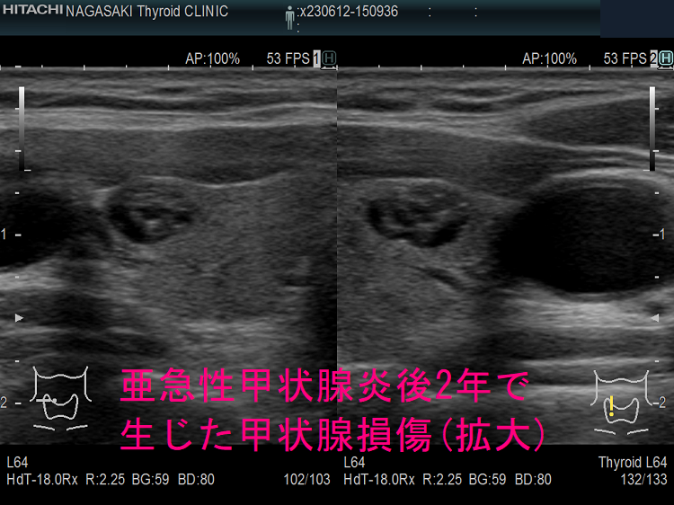 亜急性甲状腺炎後2年で生じた甲状腺損傷 超音波(エコー)画像 (拡大)