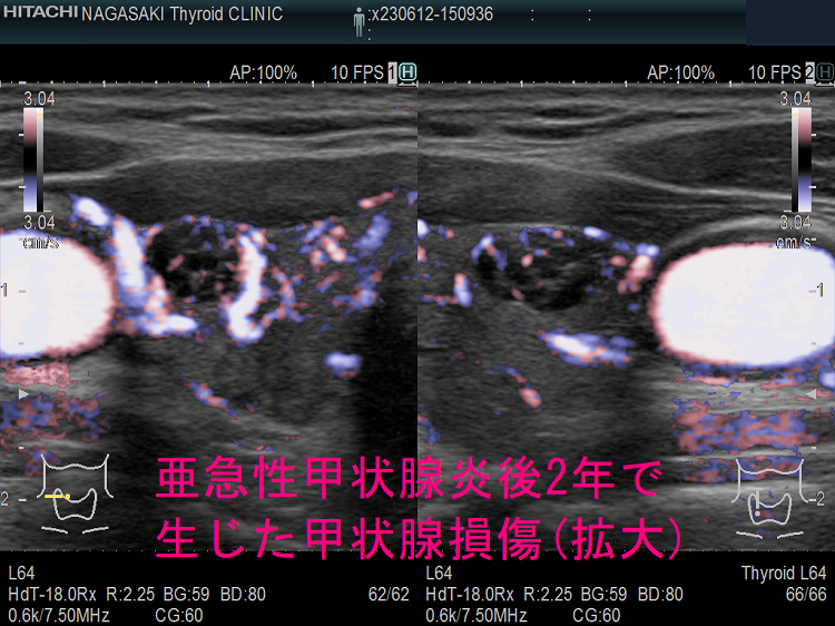 亜急性甲状腺炎後2年で生じた甲状腺損傷 超音波(エコー)画像 (拡大)ドプラーモード