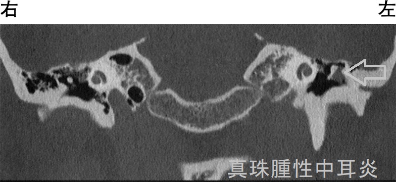 真珠腫性中耳炎2 側頭骨単純CT 真珠腫性中耳炎2 側頭骨単純CT