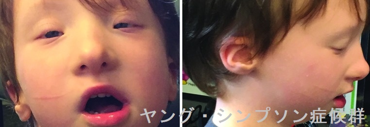 ヤング・シンプソン症候群 ヤング・シンプソン症候群