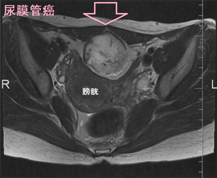 尿膜管癌 腹部MRI T2強調水平断像 尿膜管癌 腹部MRI T2強調水平断像