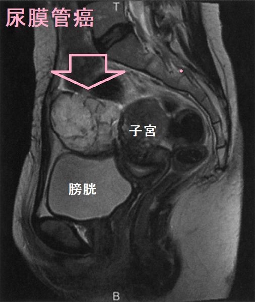 尿膜管癌 腹部MRI T2強調矢状断像 尿膜管癌 腹部MRI T2強調矢状断像