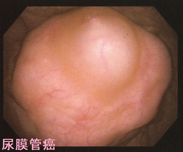 尿膜管癌 膀胱鏡像 尿膜管癌 膀胱鏡像