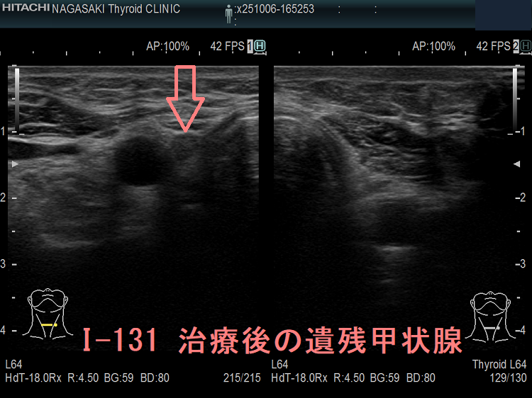 I-131 治療後の遺残甲状腺 I-131 治療後の遺残甲状腺
