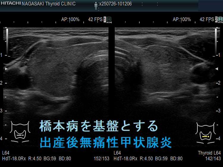 橋本病を基盤とする出産後無痛性甲状腺炎(水平断) 橋本病を基盤とする出産後無痛性甲状腺炎(水平断)