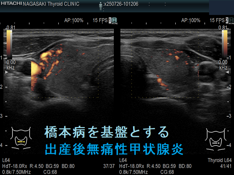 橋本病を基盤とする出産後無痛性甲状腺炎(水平断)ドプラーモード 橋本病を基盤とする出産後無痛性甲状腺炎(水平断)ドプラーモード